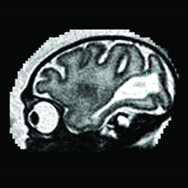 An MRI image of the fetal brain in a Zika virus infected primate. The large white region is abnormal and indicates an accumulation of fluid in the brain.